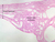 b93 interstitial uterine tube 2x labeled.jpg