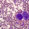 A5, Bone Marrow, 40x (Wright)
