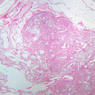A35, Lymph Node, 2.5x (H&E)