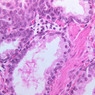 B91, Prostate, 40x (H&E)